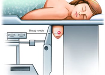 بیوپسی  یا نمونه برداری از پستان با کمک دستگاه وکیوم (مکش)